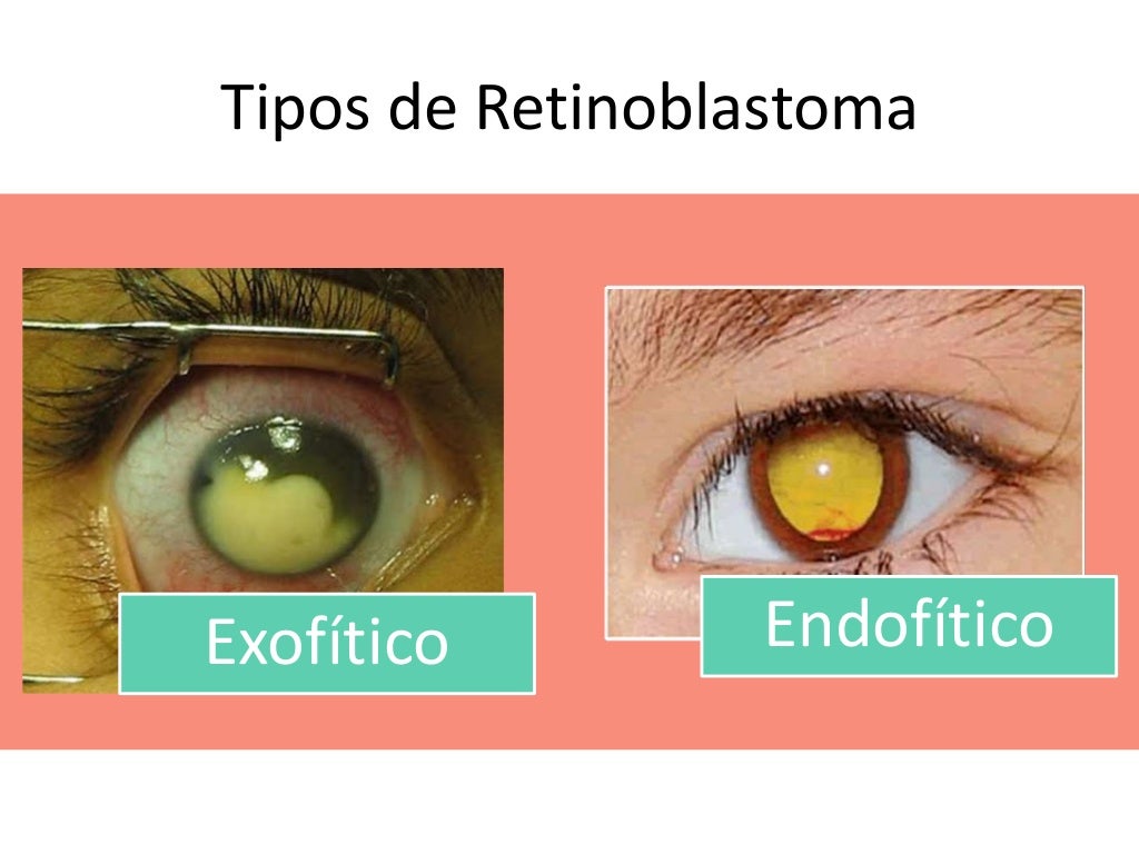 Retinoblastoma