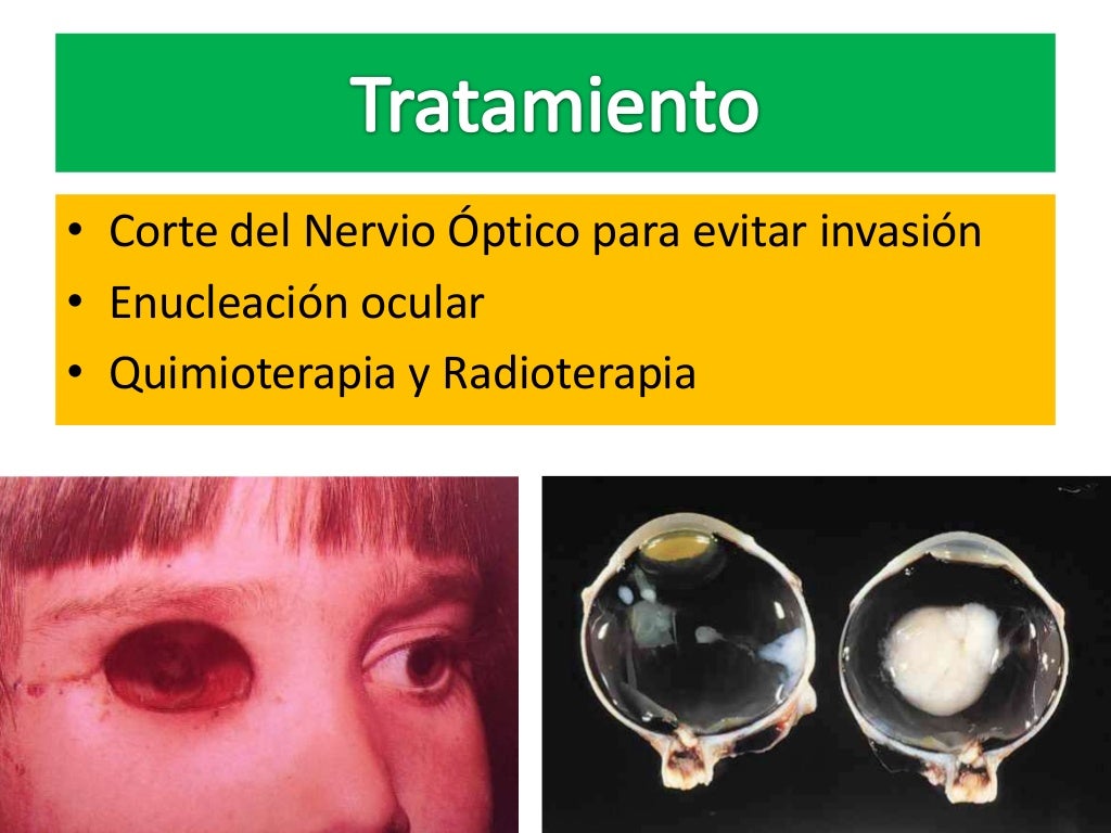 Retinoblastoma