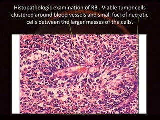 Histopathologic examination of RB . Viable tumor cells
clustered around blood vessels and small foci of necrotic
cells between the larger masses of the cells.

 