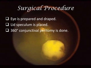 Surgical Procedure
 Eye is prepared and draped.
 Lid speculum is placed.
 360° conjunctival peritomy is done.

 