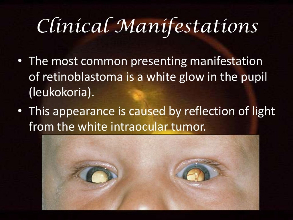 Retinoblastoma A Beginner's Guide....