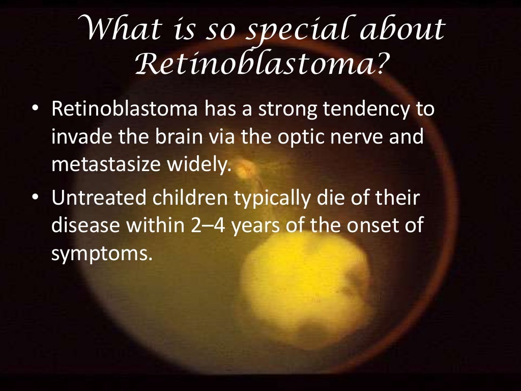 Retinoblastoma A Beginner's Guide....