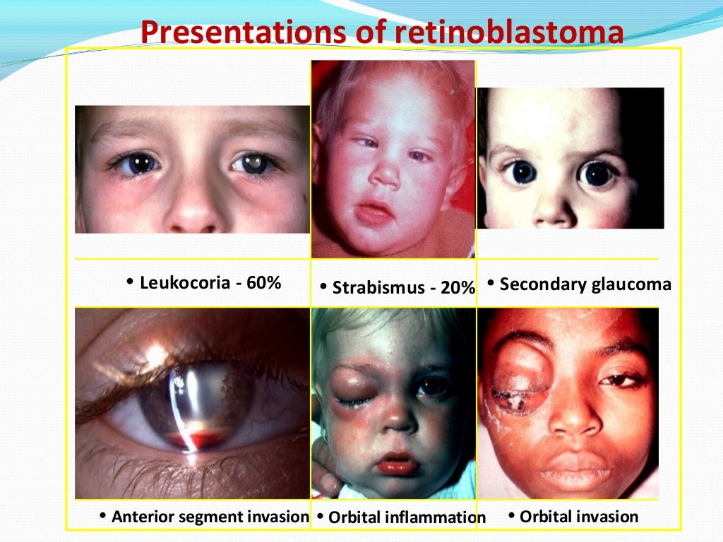 Retinoblastoma