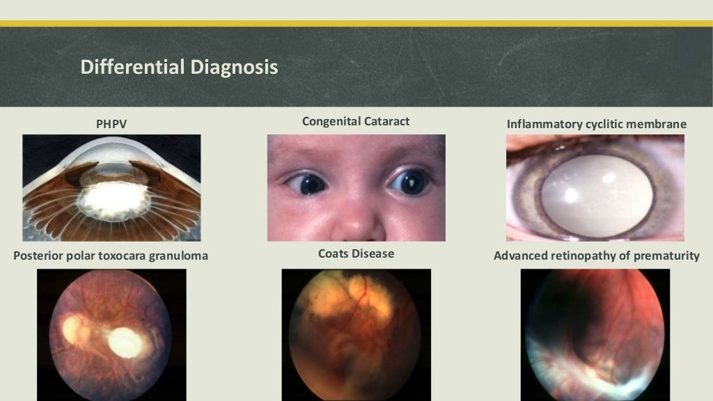Retinoblastoma Dr Shylesh B Dabke