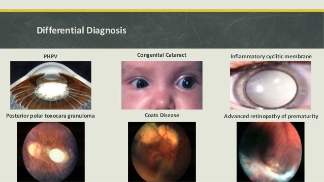 Retinoblastoma : Dr Shylesh B Dabke