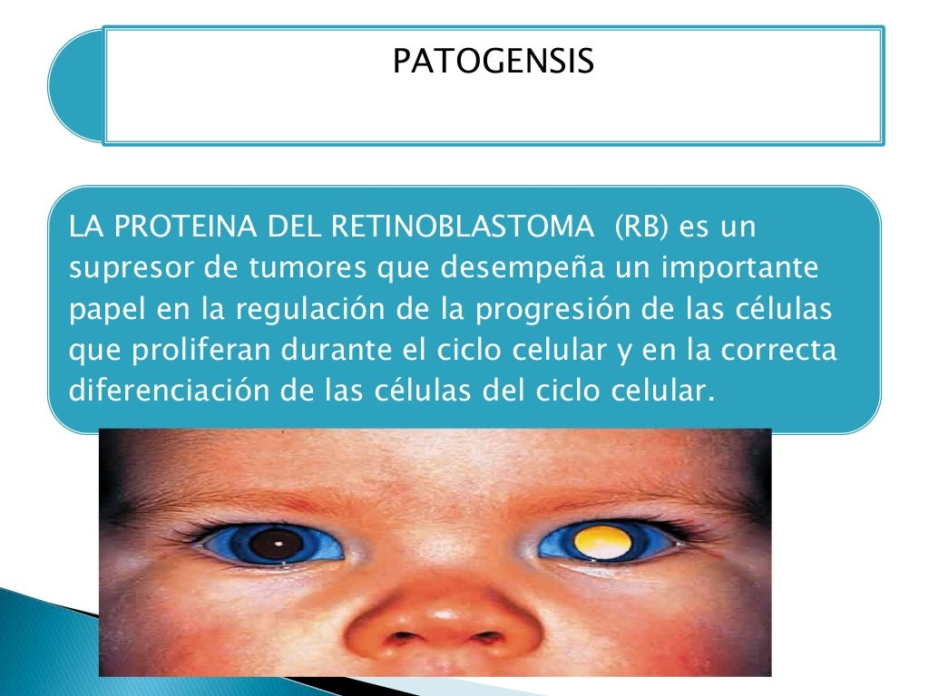 Retinoblastoma