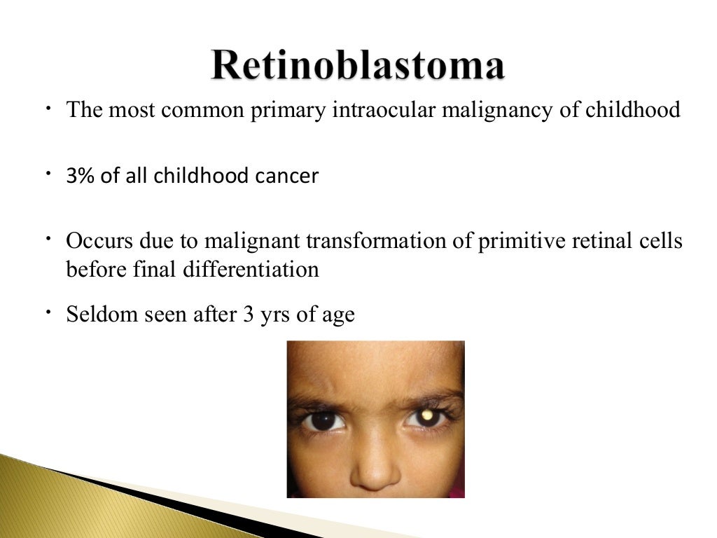 Retinoblastoma