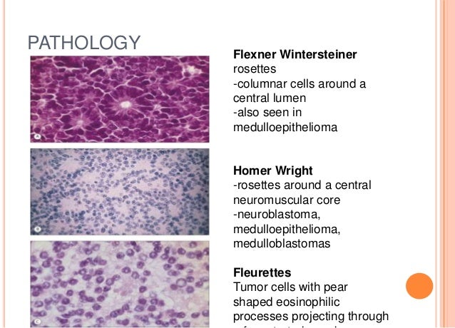 Retinoblastoma