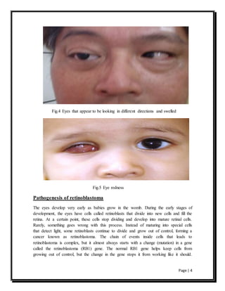 Page | 4
Fig.4 Eyes that appear to be looking in different directions and swelled
Fig.5 Eye redness
Pathogenesis of retinoblastoma
The eyes develop very early as babies grow in the womb. During the early stages of
development, the eyes have cells called retinoblasts that divide into new cells and fill the
retina. At a certain point, these cells stop dividing and develop into mature retinal cells.
Rarely, something goes wrong with this process. Instead of maturing into special cells
that detect light, some retinoblasts continue to divide and grow out of control, forming a
cancer known as retinoblastoma. The chain of events inside cells that leads to
retinoblastoma is complex, but it almost always starts with a change (mutation) in a gene
called the retinoblastoma (RB1) gene. The normal RB1 gene helps keep cells from
growing out of control, but the change in the gene stops it from working like it should.
 