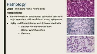 Pathology
Origin - Immature retinal neural cells
Histopathology
■ Tumour consist of small round basophilic cells with
large hyperchromatic nuclei and scanty cytoplasm
■ Highly undifferentiated or well differentiated with
– Flexner Winterseiner rosettes
– Homer Wright rosettes
– Fleuretts
 
