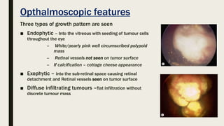 Opthalmoscopic features
Three types of growth pattern are seen
■ Endophytic – Into the vitreous with seeding of tumour cells
throughout the eye
– White/pearly pink well circumscribed polypoid
mass
– Retinal vessels not seen on tumor surface
– If calcification – cottage cheese appearance
■ Exophytic – into the sub-retinal space causing retinal
detachment and Retinal vessels seen on tumor surface
■ Diffuse infiltrating tumours –flat infiltration without
discrete tumour mass
 