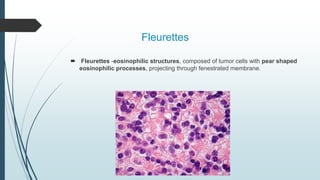 Fleurettes
 Fleurettes -eosinophilic structures, composed of tumor cells with pear shaped
eosinophilic processes, projecting through fenestrated membrane.
 