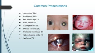 Common Presentations
 Leucocoria 56%
 Strabismus 20%
 Red painful eye 7%
 Poor vision 5%
 Asymptomatic 3%
 Orbital cellulitis 3%
 Unilateral mydriasis 2%
 Heterochromia iridis 1%
 Hyphema 1%
 