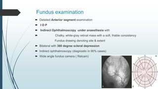 Fundus examination
 Detailed Anterior segment examination
 I O P
 Indirect Ophthalmoscopy under anaesthesia with
 Chalky, white-gray retinal mass with a soft, friable consistency
Fundus drawing denoting site & extent
 Bilateral with 360 degree scleral depression
 Indirect ophthalmoscopy (diagnostic in 90% cases)
 Wide angle fundus camera ( Retcam)
 