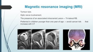 Magnetic resonance imaging (MRI)
Tumour size.
Optic nerve involvement.
The presence of an associated intracranial Lesion→ Tri-lateral RB.
Preferred in children younger than one year of age → avoid cancer risk that
increase with CT
 