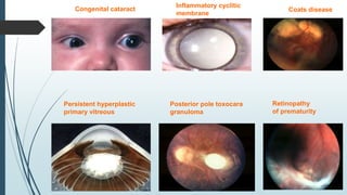 Congenital cataract
Persistent hyperplastic
primary vitreous
Inflammatory cyclitic
membrane
Coats disease
Posterior pole toxocara
granuloma
Retinopathy
of prematurity
 