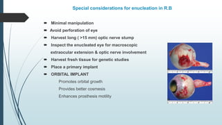 Special considerations for enucleation in R.B
 Minimal manipulation
 Avoid perforation of eye
 Harvest long ( >15 mm) optic nerve stump
 Inspect the enucleated eye for macroscopic
extraocular extension & optic nerve involvement
 Harvest fresh tissue for genetic studies
 Place a primary implant
 ORBITAL IMPLANT
Promotes orbital growth
Provides better cosmesis
Enhances prosthesis motility
 