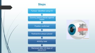 Tumour identified using I/O
Dummy plaque placed against
sclera
Position confirmed
Radioactive plaque placed
4000Gy total
Removed after 3-5 days of
placement
Steps
 