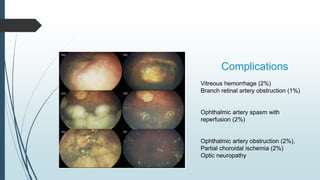 Complications
Vitreous hemorrhage (2%)
Branch retinal artery obstruction (1%)
Ophthalmic artery spasm with
reperfusion (2%)
Ophthalmic artery obstruction (2%),
Partial choroidal ischemia (2%)
Optic neuropathy
 