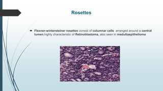 Rosettes
 Flexner-wintersteiner rosettes consist of columnar cells arranged around a central
lumen,highly characteristic of Retinoblastoma, also seen in medulloepithelioma
 