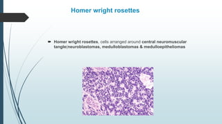 Homer wright rosettes
 Homer wright rosettes, cells arranged around central neuromuscular
tangle(neuroblastomas, medulloblastomas & medulloepitheliomas
 