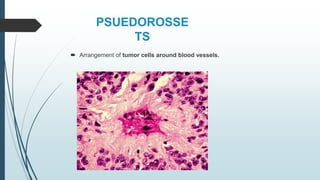 PSUEDOROSSE
TS
 Arrangement of tumor cells around blood vessels.
 