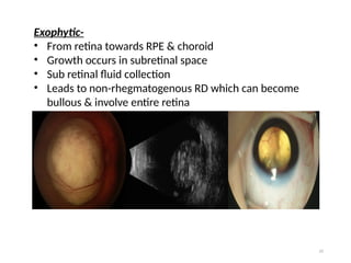 Retinoblastoma tumor of eye in ophthalmology.pptx