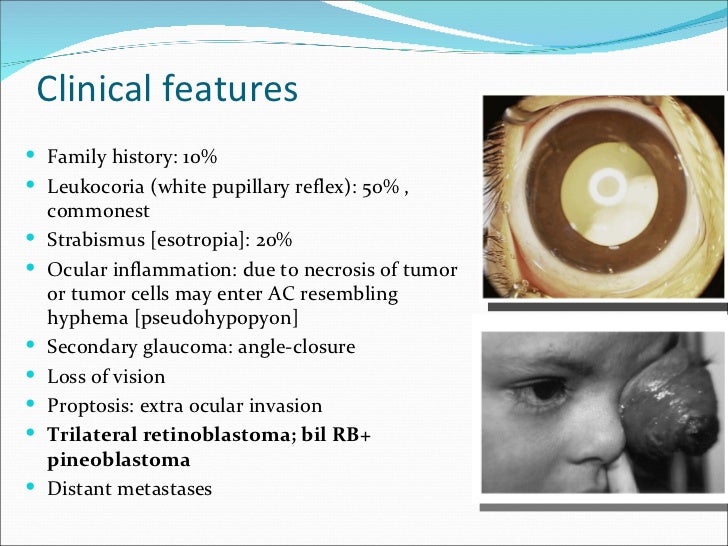 Retinoblastoma dr vandana