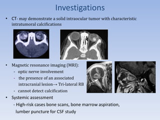 Investigations
• CT- may demonstrate a solid intraocular tumor with characteristic
intratumoral calcifications
• Magnetic resonance imaging (MRI):
- optic nerve involvement
- the presence of an associated
intracranial lesion→ Tri-lateral RB
- cannot detect calcification
• Systemic assessment
- High-risk cases bone scans, bone marrow aspiration,
lumber puncture for CSF study
 