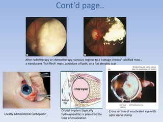 Cont’d page..
After radiotherapy or chemotherapy, tumours regress to a ‘cottage-cheese’ calcified mass ,
a translucent ‘fish-flesh’ mass, a mixture of both, or a flat atrophic scar
Locally administered Carboplatin
Orbital implant (typically
hydroxyapatite) is placed at the
time of enucleation
Cross section of enucleated eye with
optic nerve stamp
 