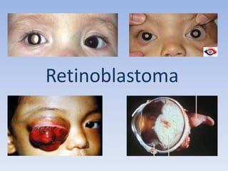 Retinoblastoma
 