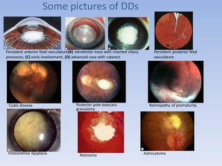 Some pictures of DDs
Persistent anterior fetal vasculature(B) retrolental mass with inserted ciliary
processes; (C) early involvement; (D) advanced case with cataract
Persistent posterior fetal
vasculature
Coats disease Posterior pole toxocara
granuloma
Retinopathy of prematurity
Vitreoretinal dysplasia Retinoma Astrocytoma
 