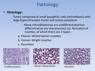 Pathology
• Histology:
Tumor composed of small basophilic cells (retinoblasts) with
large hyperchromatic nuclei and scanty cytoplasm
- Many retinoblastomas are undifferentiated but
differentiation are characterized by formation of
rosettes, of which there are 3 types -
a. Flexner–Wintersteiner rosettes
b. Homer–Wright rosettes
c. Fleurettes
FleurettesFlexner–WintersteinerUndifferentiated
 