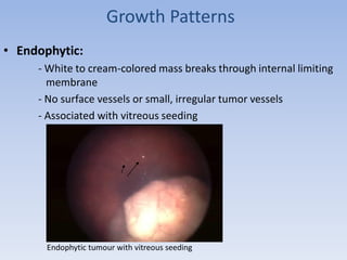 Growth Patterns
• Endophytic:
- White to cream-colored mass breaks through internal limiting
membrane
- No surface vessels or small, irregular tumor vessels
- Associated with vitreous seeding
Endophytic tumour with vitreous seeding
 