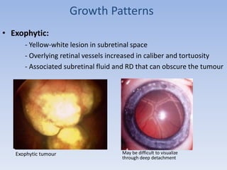 Growth Patterns
• Exophytic:
- Yellow-white lesion in subretinal space
- Overlying retinal vessels increased in caliber and tortuosity
- Associated subretinal fluid and RD that can obscure the tumour
May be difficult to visualize
through deep detachment
Exophytic tumour
 