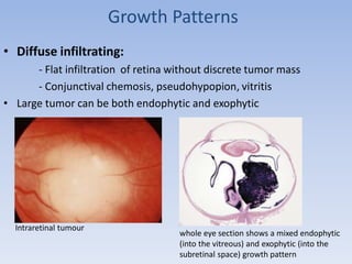 Growth Patterns
• Diffuse infiltrating:
- Flat infiltration of retina without discrete tumor mass
- Conjunctival chemosis, pseudohypopion, vitritis
• Large tumor can be both endophytic and exophytic
Intraretinal tumour
whole eye section shows a mixed endophytic
(into the vitreous) and exophytic (into the
subretinal space) growth pattern
 