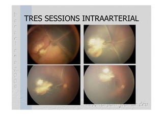 TRES SESSIONS INTRAARTERIAL
 