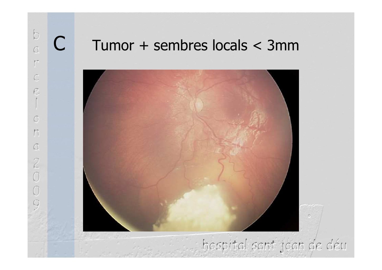 Avances en el tratamiento del retinoblastoma