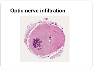 Optic nerve infiltration
 
