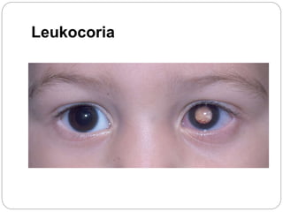 Leukocoria
 