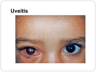 Uveitis
 