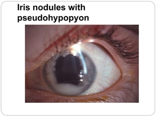 Iris nodules with
pseudohypopyon
 