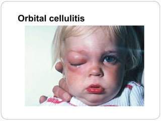 Orbital cellulitis
 