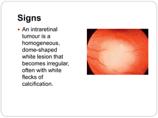 Signs
 An intraretinal
tumour is a
homogeneous,
dome-shaped
white lesion that
becomes irregular,
often with white
flecks of
calcification.
 