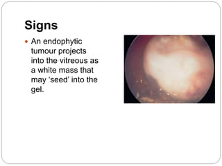 Signs
 An endophytic
tumour projects
into the vitreous as
a white mass that
may ‘seed’ into the
gel.
 