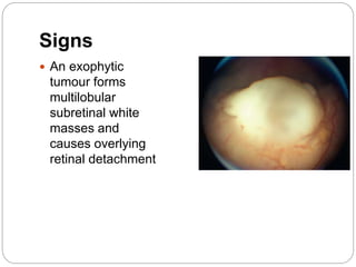 Signs
 An exophytic
tumour forms
multilobular
subretinal white
masses and
causes overlying
retinal detachment
 