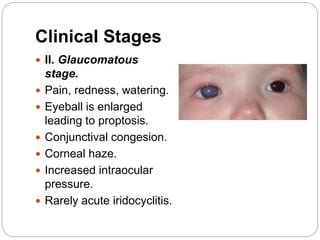 Clinical Stages
 II. Glaucomatous
stage.
 Pain, redness, watering.
 Eyeball is enlarged
leading to proptosis.
 Conjunctival congesion.
 Corneal haze.
 Increased intraocular
pressure.
 Rarely acute iridocyclitis.
 