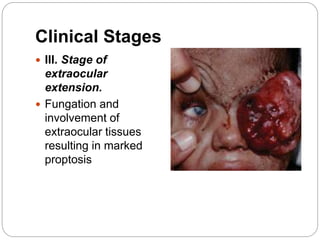 Clinical Stages
 III. Stage of
extraocular
extension.
 Fungation and
involvement of
extraocular tissues
resulting in marked
proptosis
 