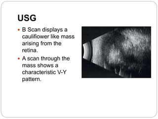 USG
 B Scan displays a
caulifiower like mass
arising from the
retina.
 A scan through the
mass shows a
characteristic V-Y
pattern.
 