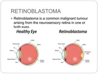RETINOBLASTOMA
 Retinoblastoma is a common malignant tumour
arising from the neurosensory retina in one or
both eyes.
 